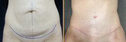 Abdominoplastie – rezultat