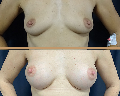 Augmentare mamara – caz 4