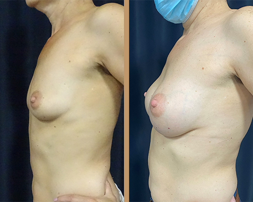 Augmentare mamara – caz 6