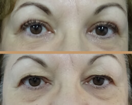 Blefaroplastie superioară – înainte