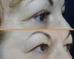 Blefaroplastie superioară – după