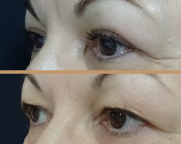 Blefaroplastie superioară – caz 2