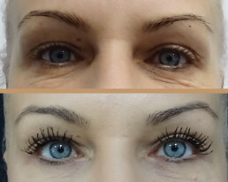 Blefaroplastie inferioară – înainte
