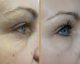 Blefaroplastie inferioară – după
