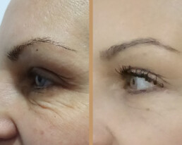 Blefaroplastie inferioară – caz 2
