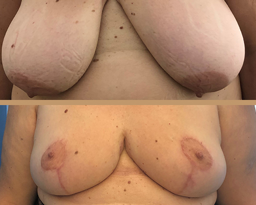Mamoplastie reducere – caz 1
