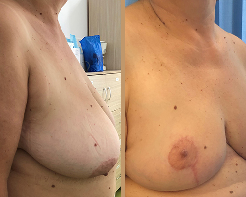 Mamoplastie reducere – caz 3