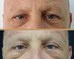 Blefaroplastie bărbați – caz 4