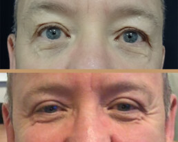 Blefaroplastie bărbați – caz 1