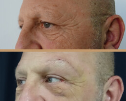Blefaroplastie bărbați – caz 5