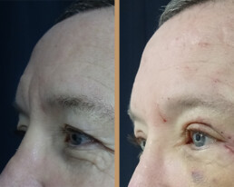 Blefaroplastie bărbați – caz 2