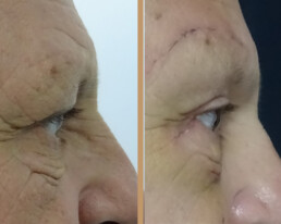 Blefaroplastie bărbați – caz 6