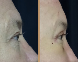 Blefaroplastie bărbați – caz 3