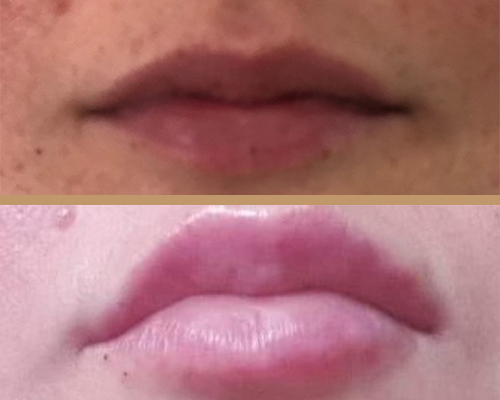 Rejuvenare facială – buze