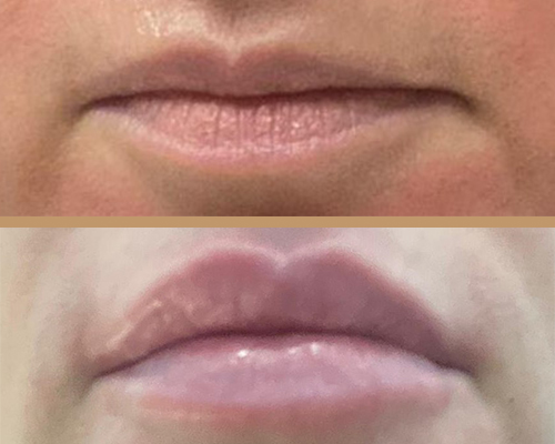 Rejuvenare facială – volum