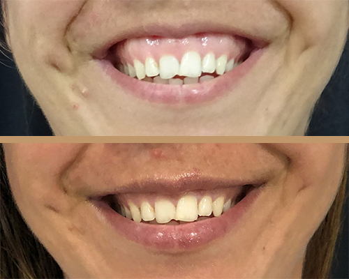 Rejuvenare – gummy smile